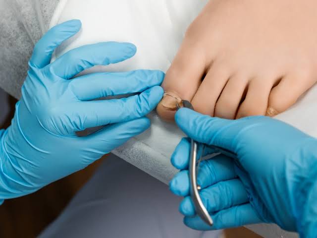 Ingrown Toenail Procedures - Velura Clinic